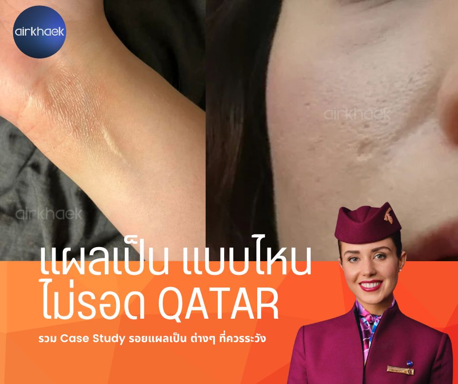 แผลเป็น สายการบิน กาตาร์ Qatar Airways